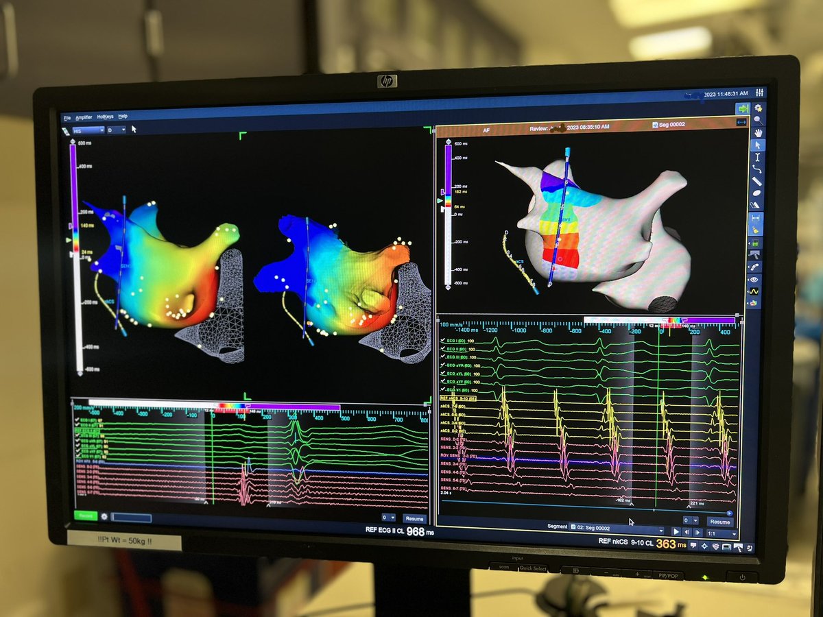 Brock Gambill (@forkknifecab_ep) on Twitter photo #SensiTherm EGM snapshot of passive left atrial posterior wall activation during atrial flutter (right image), induced post Cryo AF ablation. <a href="/AbbottCardio/">Abbott Cardiovascular</a> <a href="/Arek_EP/">Arek Karagoezian</a> <a href="/EPS_PDX/">D Randy Jones</a> #SensiTherm EGM snapshot of passive left atrial posterior wall activation during atrial flutter (right image), induced post Cryo AF ablation. <a href="/AbbottCardio/">Abbott Cardiovascular</a> <a href="/Arek_EP/">Arek Karagoezian</a> <a href="/EPS_PDX/">D Randy Jones</a>