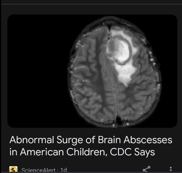 “The United States saw a 200% increase in brain abscesses in children in December 2022” 😢