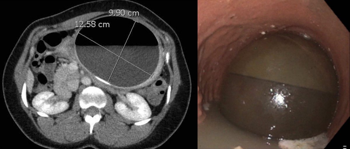 Weight Loss Success With Repeat Intragastric Balloon Placement After Hyperinflation & Removal of Index Balloon 

▪️⚠️ Hyperinflation of 🎈
▪️Symptoms of GOO
▪️Prompt removal 🎈
▪️Consider replacement 

👏@MichaelCraig_MD @CarlKayMD @ktswick

@ACGCRJ

🔗journals.lww.com/acgcr/Fulltext…