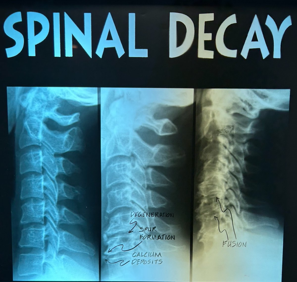Chiropractic care is a preferred treatment option for degenerative disc disease for a variety of reasons.

#abetterwaychiropractic #abetterway #betterthandrugs #chiropractor #chiropractic #getadjusted #chiropracticadjustment #spinehealth #spine #chiropractortiktok #spinalhygiene