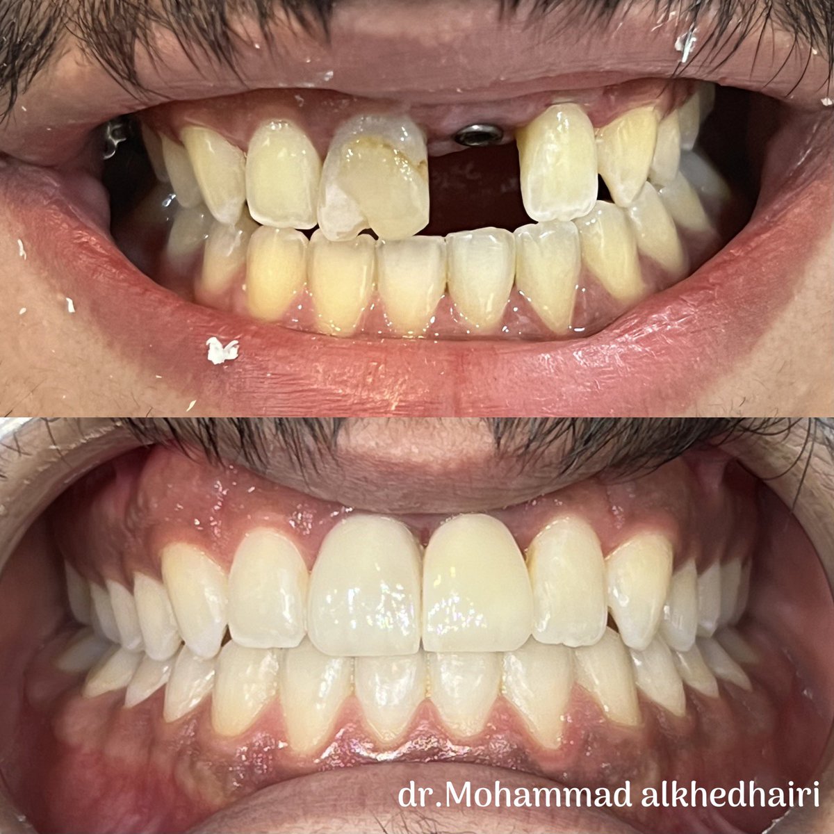 DrAlkhedhairim's tweet image. حاله تجميله لزراعة سن امامي وعدسه للسن المجاور فقط 💯💯
فرق كبير بالابتسامه بلمسات بسيطه 👌🏻
.
a case with Implant supported prosthesis for tooth #21 and a veneer for tooth #11 only
#dental #implant #prosthesis #esthetics #veneer #dentistry #زراعة_اسنان #عدسات #تجميل #الاسنان