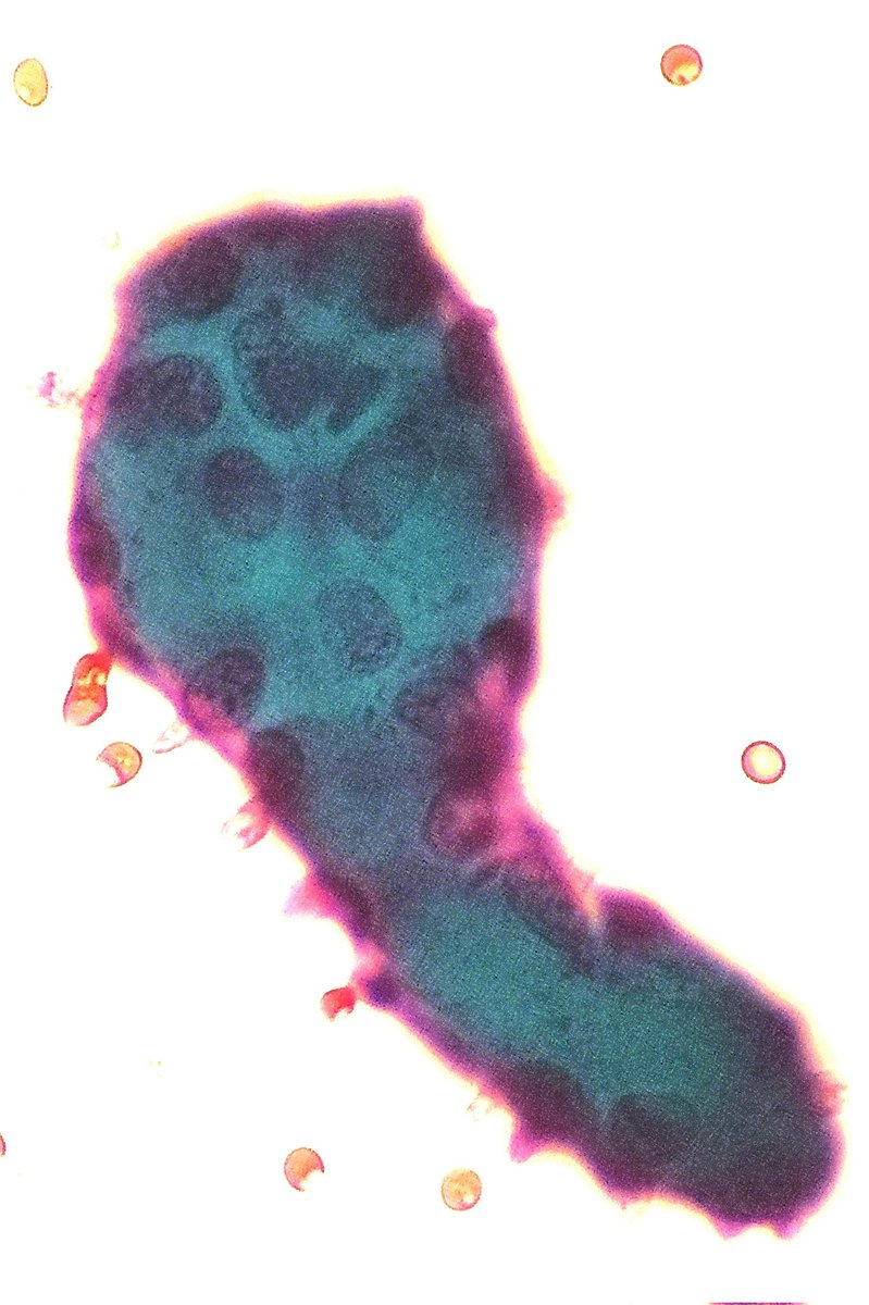 ✨COLLAGEN BALLS ✨

it is not uncommon to see them in #cytology samples from peritoneal washings, together with large sheets of benign mesothelial cells, perhaps a little angry..