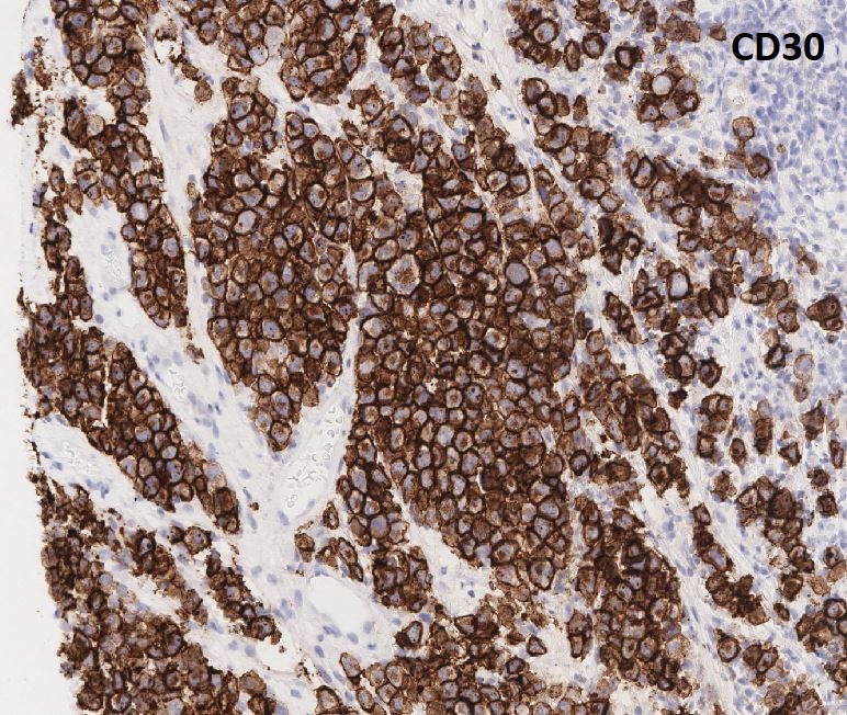 A diff-Quik-stained smear of ALK(+) anaplastic large cell lymphoma contains hallmark cells. 

Diagnosis confirmed by H&E and IHC. #cytopath #cytology #cytopathology #pathology