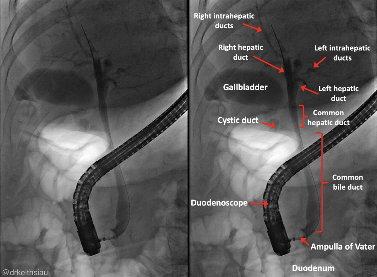 drkeithsiau's tweet photo. Anatomy of the bile ducts as seen during ERCP #4KMedEd https://t.co/JZiATTVtlZ