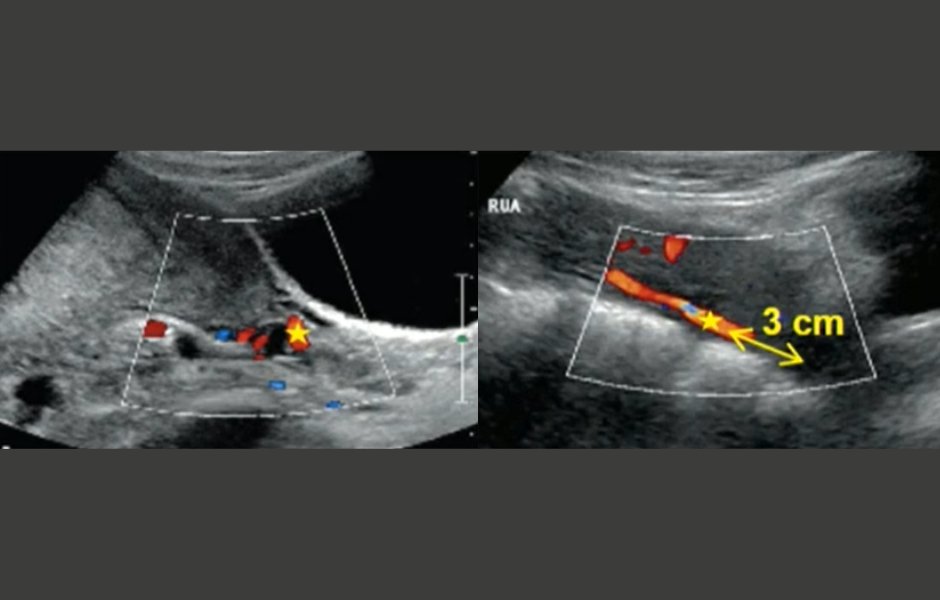 #PreeclampsiaAwarenessMonth #ISUOG Quiz: What is the preferred ultrasound index for preeclampsia screening in the first trimester?
a. Mean uterine artery PI
b. Mean uterine artery RI
c. Lower uterine artery PI 
Check out our pre-eclampsia resources here: bit.ly/3MVU0ok