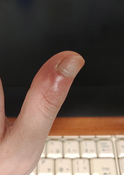 前に書いてた左親指の炎症っぽい所に大分膿が溜まったのを確認出来たのでマチ針を消毒して皮膚に穴を開けて膿を出しました。😣
この程度の物でこれだけ膿が溜まるのか～!😮
膿を出した今は痛みはほぼ治まってますね～。🙂
化膿性爪囲炎とか言う細菌性の物らしいよ。🧐
写真は経過。3枚目膿注意!😡 