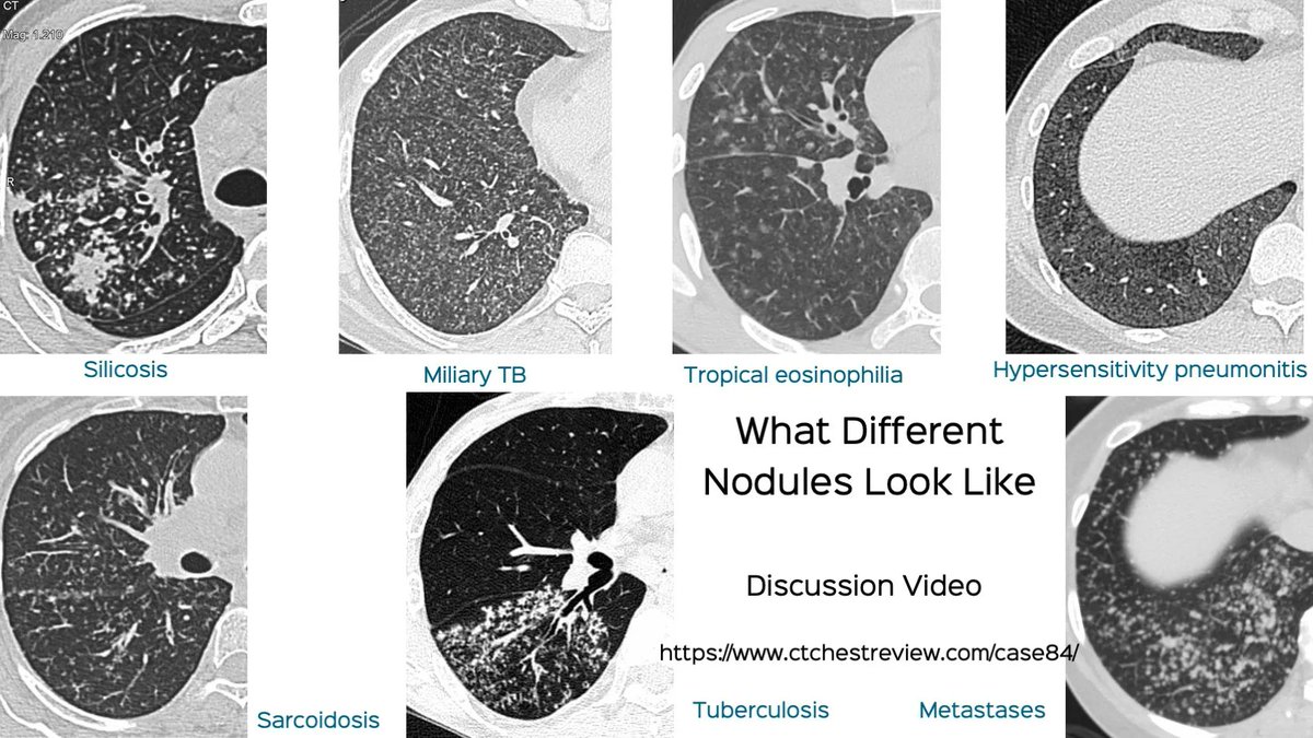 Causes of Small Lung Nodules

Discussion video

ctchestreview.com/case84/

#chestrad #ctchest #FOAMrad #radres #lungnodules
