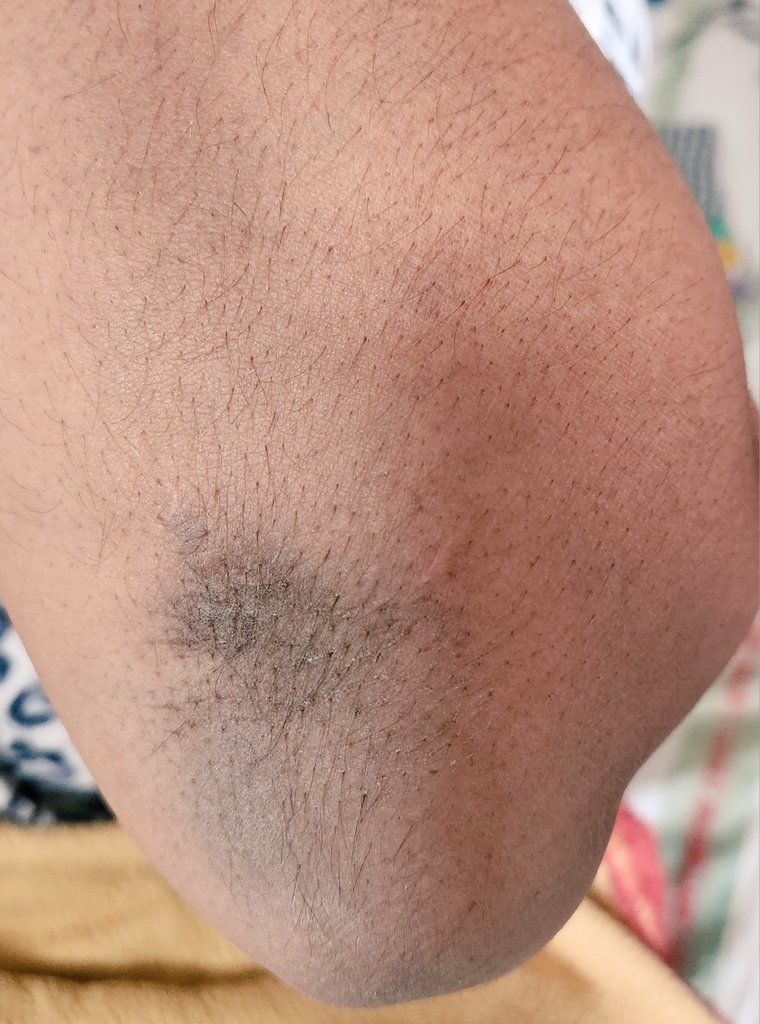 priti899's tweet image. 💥Hey #NephTwitter
#Medtwitter Pt of Membranous Nephropathy on Modified Ponticelli .
 🔰Recently  developed hyperpigmentation on various body parts !

Could it be related to drug therapy ❓️
@Ask_Renal #askrenal 

✔️Posted after pt consent