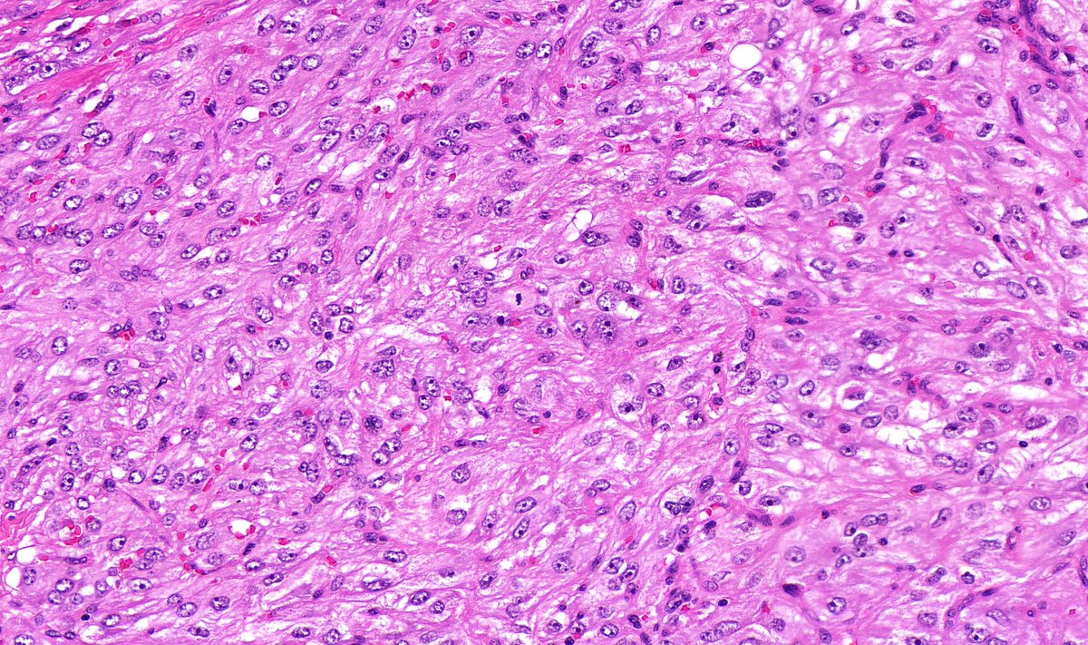 Small bowel, Adult

#GIpath #BSTpath #Pathresidents #PathTwitter