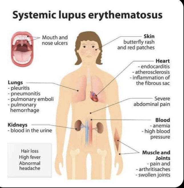 Life with lupus
#LupusWarrior 🦋👊🏻💪🏻
#LupusAwarenessMonth