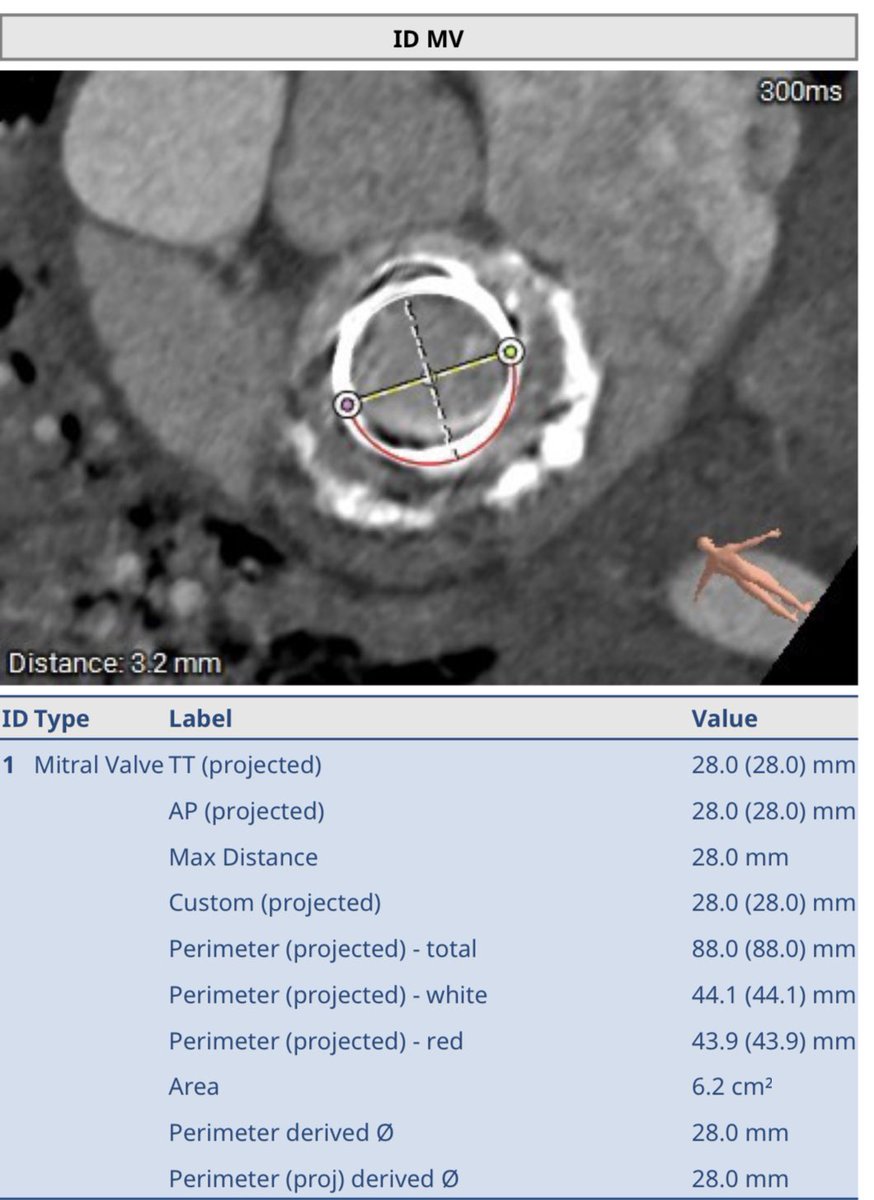 Great result in a complex TS ViV Mitral for a failed Perimount 33mm, where a 29mm S3 valve was implanted. Well done <a href="/EeLingHeng1/">Ee Ling Heng</a>, Dr Rob Smith, Dr Majid Akhtar, <a href="/dralisonduncan/">Alison Duncan</a> &amp; <a href="/RoyalBrompton/">Royal Brompton</a> team