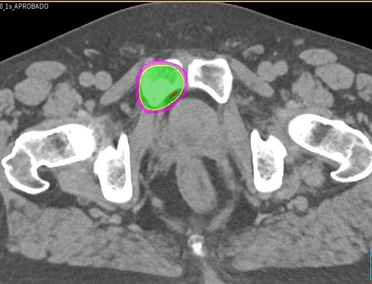 Estamos pletóricos  por contaros nuestro 🥇 paciente tratado con SBRT  🦴 en 1️⃣ sesión de 20 Gy
✔️ Tratamiento ablativo 
✔️ Toxicidad escasa
✔️ Excelentes resultados en CL y SG
Gracias a todo el equipo ☢️
@TorrecardenasHU 
#laradioterapiacura #safron2 #yosoyradiooncologo