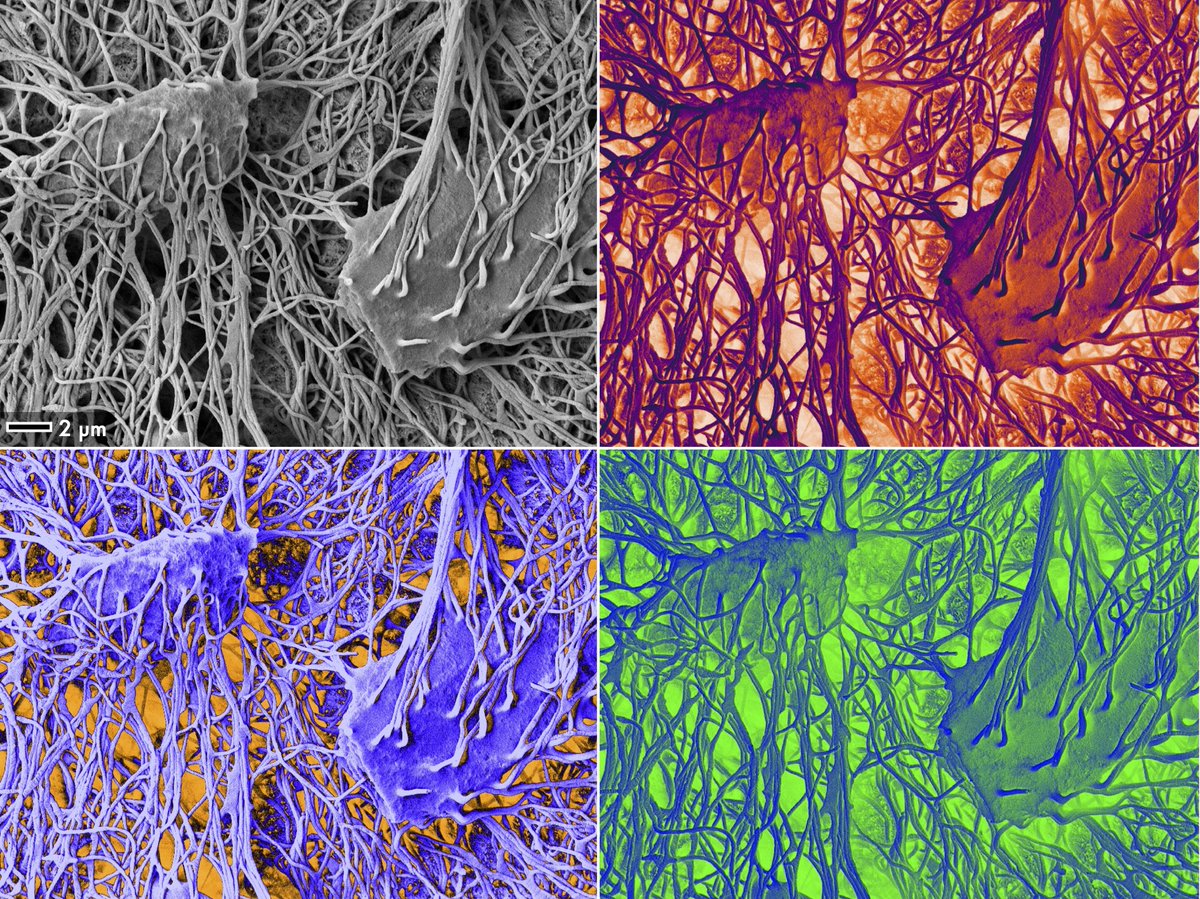 🦴🔬#Osteocyte – the master orchestrator of #bone #remodeling. ~42 billion in the average adult human skeleton, #osteocytes make up ~90–95% of all #cells within bone, interconnected by ~3.7 trillion dendritic projections with an estimated, total end-to-end length of 175,000 km🔍