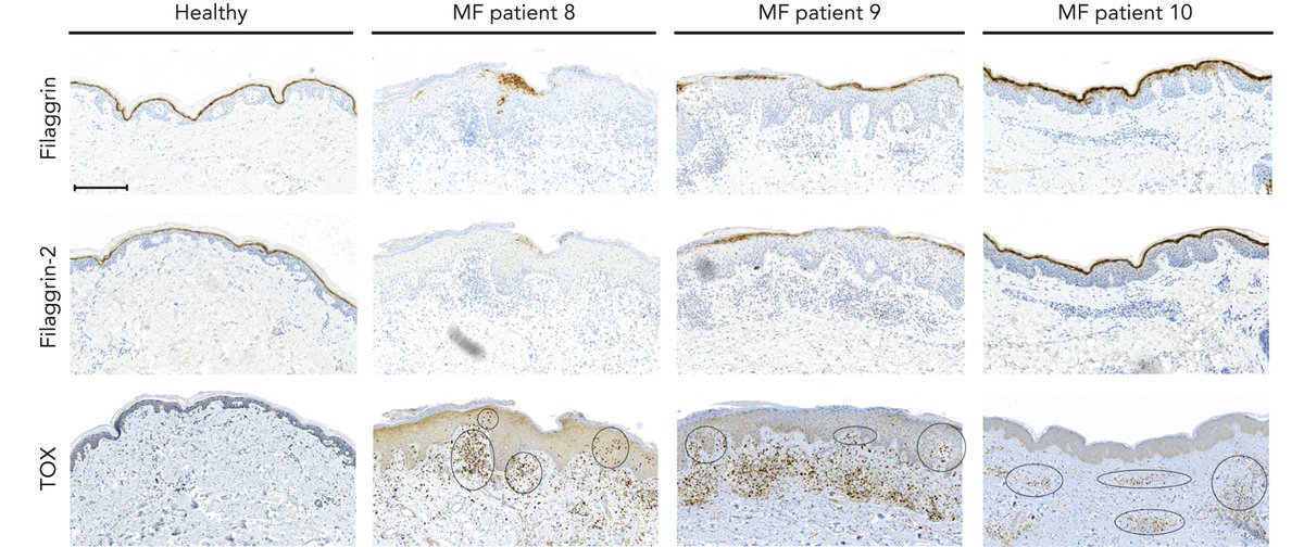 Malignant (cancer) T cells in CTCL express high levels of the TOX protein. Association of defective skin barrier and TOX+ cells close to epidermis suggest that the defect may be caused by the proximity of malignant T cells and epidermal keratinocytes.