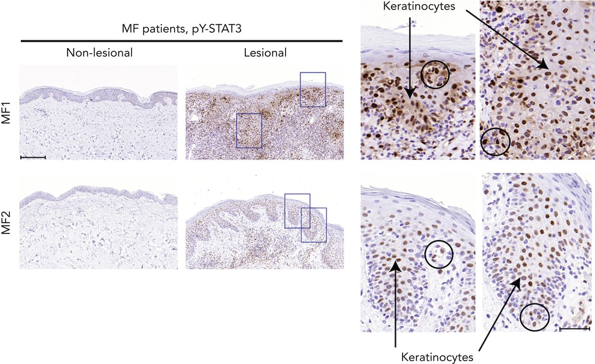JAK/STAT3 signaling plays a key role in repression of FLG in inflammatory skin disorders but little is known about STAT3 activity CTCL skin. We found strong STAT3 activation in T cells and keratinocytes in lesional, but not in non-lesional, skin of CTCL patients.