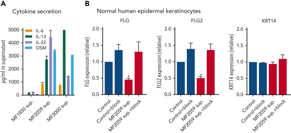 Several cytokines can repress FLG through JAK1/STAT3 signaling in keratinocytes. We found high levels of IL-6, IL-13, IL-22 and OSM secreted by malignant T cells. Blocking these completely counteracted the effect of malignant T cells on FLG expression in keratinocytes.