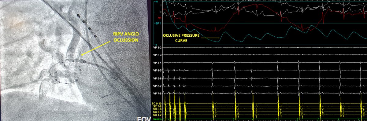 ArritmiasGr's tweet photo. Nice case today at Virgen de las Nieves: Focal RIPV-AF. Incessant paroxysmal AF at the beginning. Very early RPIV potential-trigger (Fig.1). After 👌oclussion (Fig.2) the potential sequencially stopped inducig AF, exit block and finally isolated (Fig.3). No more AF. With @pjsm83 https://t.co/BbkhJe2q4p