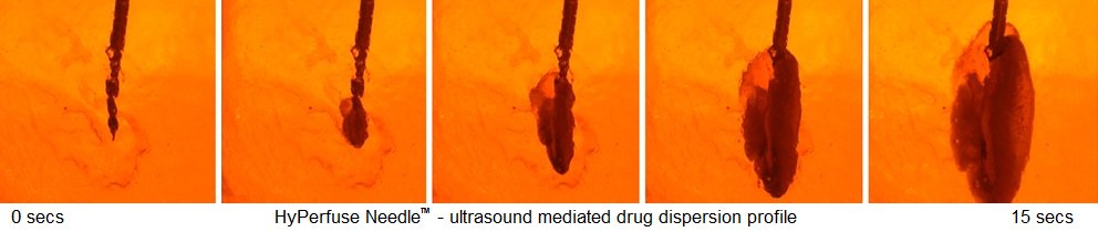 <a href="/ActiveNeedle/">ActiveNeedle</a> is excited to announce that our #ultrasound-mediated #drugdelivery device, #HyPerfuseNeedle™ has now gained lab verified proof of its ability to deliver clinically significant improvements in #intratumoural drug perfusion in a tumour bearing mouse model.

#Cancer