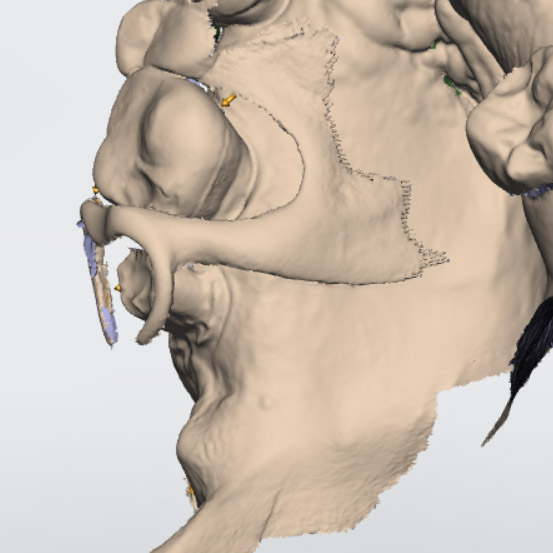 Confused by the technique for scanning a crown under an existing partial?  Check out our guide (and more on our downloads page).

ow.ly/S8oh50OwoYC