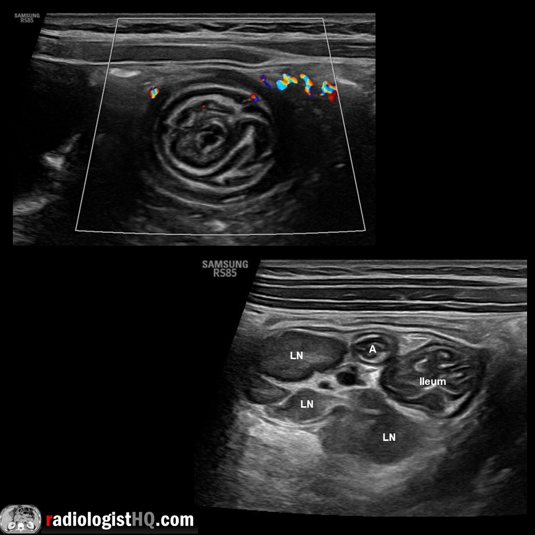 Ileocolic intussusception with target sign (top), containing ileum, appendix (A) & lymph nodes (LN). AP ileocolic diameter >2 cm, most common in children >3 months old. Watch📽️ to learn more: bit.ly/rhq-intus

@BostonImaging @SamsungHealth #FOAMrad #FOAMed #usrad #pedsrad