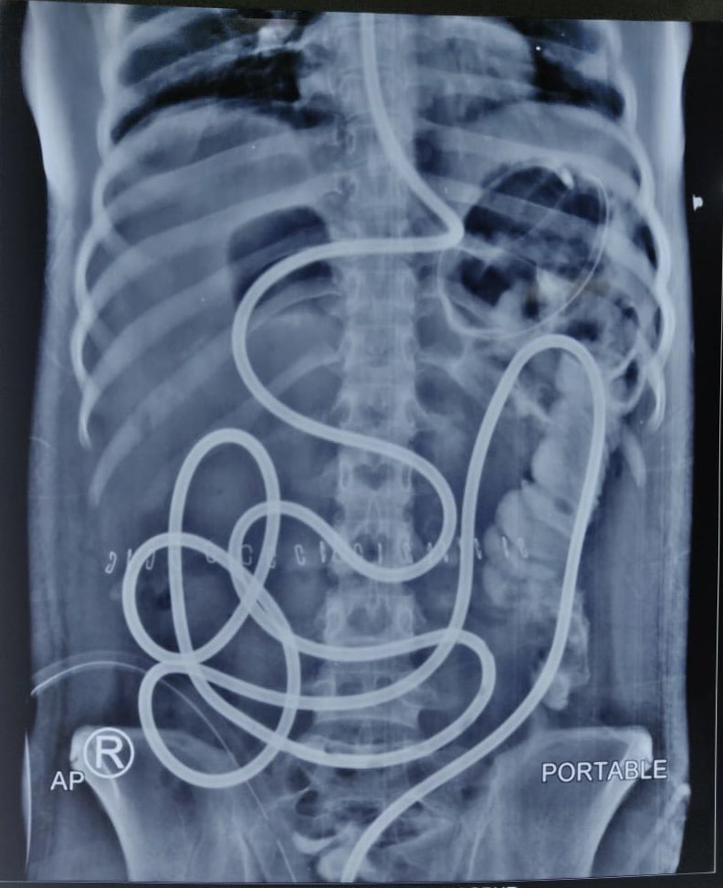 What’s happening here? <a href="/drkeithsiau/">Keith Siau</a> <a href="/DharJahnvi/">Jahnvi Dhar</a> <a href="/helpatologist/">Nadeem Tehami</a> <a href="/ChahalPrabhleen/">Prabhleen Chahal MD,MASGE,FACG</a> <a href="/stevenbollipo/">Steven Bollipo</a> <a href="/DrAnuraagJ/">Anuraag Jena</a> <a href="/SDolwani/">Sunil Dolwani</a> <a href="/ZaheerNabi8/">Zaheer Nabi</a> <a href="/ibd_pal/">Partha Pal</a> <a href="/profplal/">Pawanindra Lal</a> <a href="/Jayanta_sam/">Jayanta Samanta</a> <a href="/EndoTx/">Todd H Baron MD, MASGE</a>