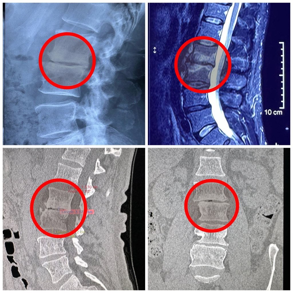 pterion77's tweet photo. Pte 60, lumbalgia crónica, colapso L2-L3, llevado a cirugía miss 360 grados por vía lateral transpsoas más tornillos, “single position Surgery”, alta al siguiente día, @pablopenatapia @HospitaldelRio #singlepositionlateral #miss #spinesurgery #colunavertebral #columnavertebral https://t.co/7ZJk4XR0tO
