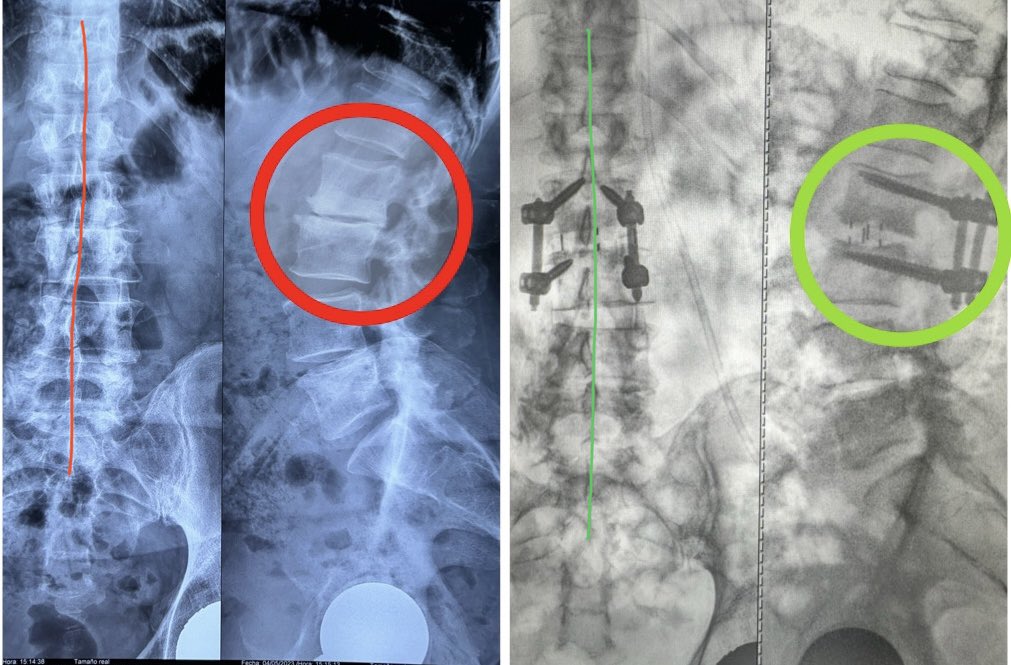 pterion77's tweet photo. Pte 60, lumbalgia crónica, colapso L2-L3, llevado a cirugía miss 360 grados por vía lateral transpsoas más tornillos, “single position Surgery”, alta al siguiente día, @pablopenatapia @HospitaldelRio #singlepositionlateral #miss #spinesurgery #colunavertebral #columnavertebral https://t.co/7ZJk4XR0tO