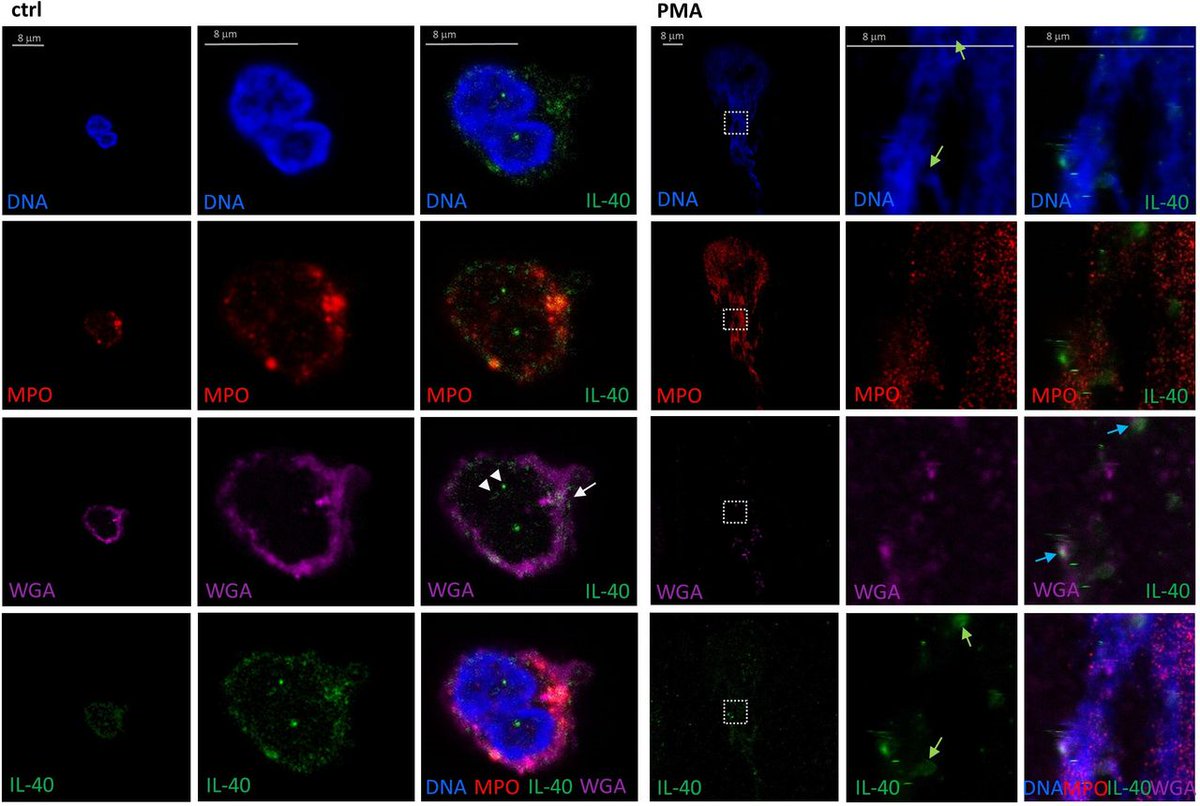 eular_ARD's tweet image. 📢 New kid on the block: IL-40 
⬆️ elevated in RA serum
🕸 associated with #NETosis markers
🔵 secreted by #neutrophils

Find the whole story here👉rmdopen.bmj.com/content/9/2/e0…

#openaccess