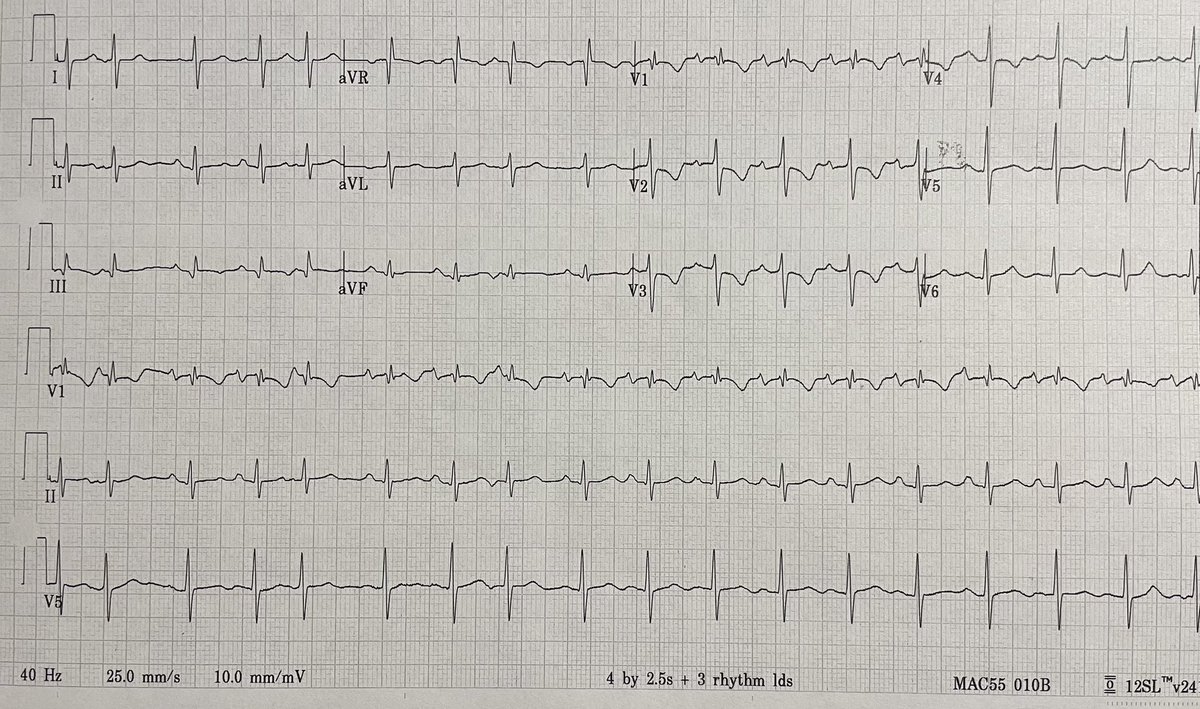 Was texted this ECG. ED consult for new chest pain. Early 40’s male. No reported ASCVD risk factors. Troponin I pending. #CardioTwitter #Cardiology #FOAMed #MedTwitter