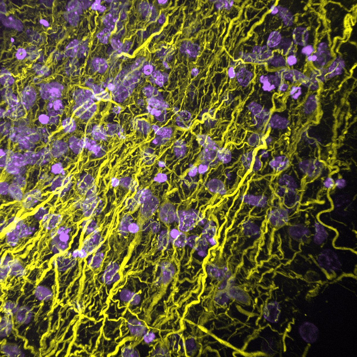 Fluorescent neurons in a cerebral organoid
#FluorescenceFriday #SciArt #Popart #brainorganoid #cerebralorganoid #mylittlebrainorganoid