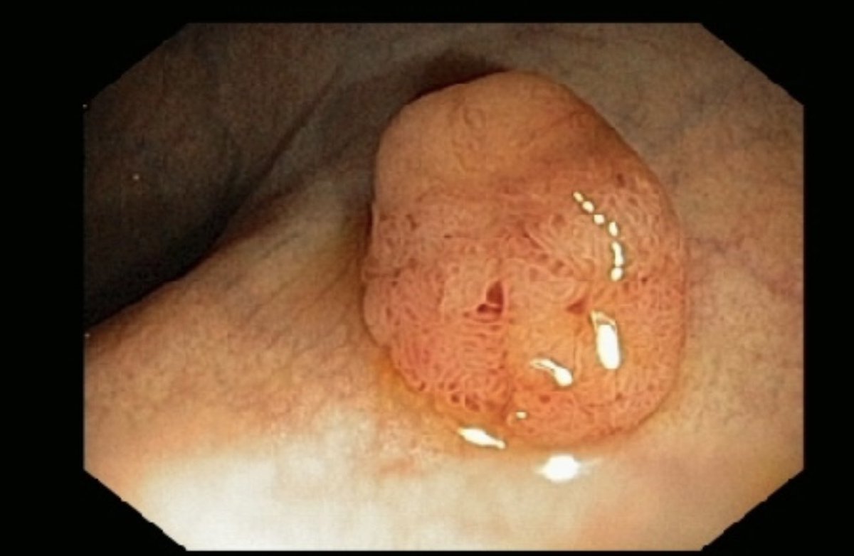 ScottRSteeleMD's tweet photo. #quickcase. On surveillance scope for a 51 patient with prior polyps, you see the following lesion in mid-rectum. Snare removal reveals t1 moderately differentiated cancer with positive deep margin. CT & MRI negative. CEA 3.3. How do you proceed? https://t.co/H1P5x3zn89