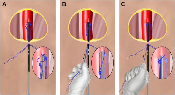 Tautening, traveling of perclose knot is critical to achieving hemostasis with minimal to no bleeding. When using MCS in shock, these same principles are needed to limit risk of complications. Hence in my opinion almost every case should be pre-perclosed if possible.