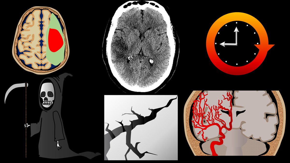 1/Time is brain! So you don’t have time to struggle w/that stroke alert head CT. Here’s a #tweetorial to help you with the CT findings in acute stroke. #medtwitter #FOAMed #FOAMrad #ESOC #medstudent #neurorad #radres #meded #radtwitter #stroke #neurology #neurotwitter