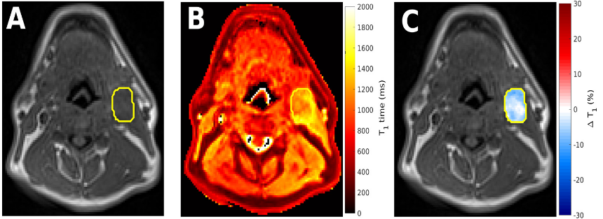 #OpenAccess Review
T1 based oxygen-enhanced MRI in tumours; a scoping review of current research
bit.ly/3JjTIbn
#Radiology #MRI #FOAMed