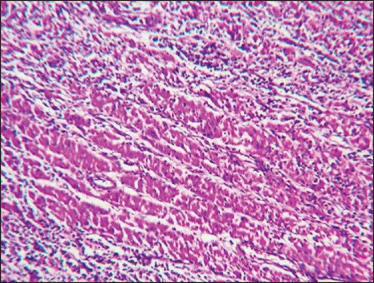 pathobotology's tweet photo. #Pathology #quiz!
1. What tissue is this (#gipath)?
2. What is in your differential?
3. What is your diagnosis? #WiyD
Case details will be posted as a reply soon! https://t.co/B8ug61fQUH