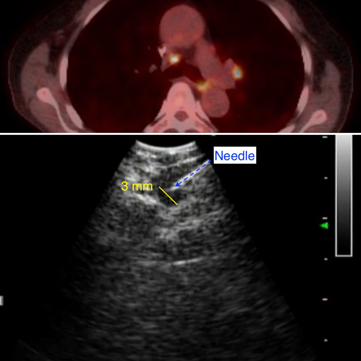 Ali Abedi MD FCCP DAABIP (@docabedi) on Twitter photo Have needle, will sample!
When there’s a need, there’s a way.
Tiny (3-5 mm) but persistently PET active mediastinal LN in a patient on treatment for lymphoma.
Effectively sampled with 22g EBUS-TBNA.
With <a href="/pulmo_dok/">Napoleon Puente</a> Have needle, will sample!
When there’s a need, there’s a way.
Tiny (3-5 mm) but persistently PET active mediastinal LN in a patient on treatment for lymphoma.
Effectively sampled with 22g EBUS-TBNA.
With <a href="/pulmo_dok/">Napoleon Puente</a>