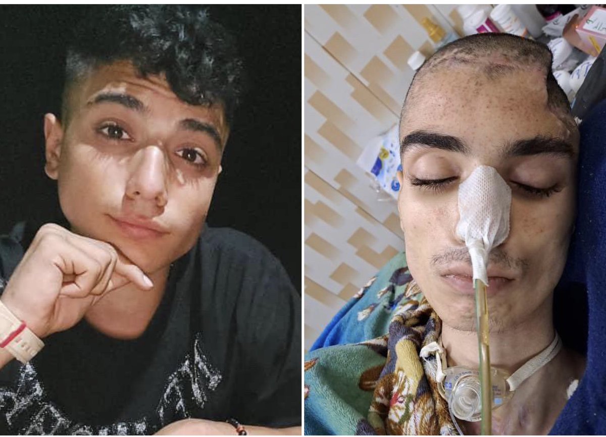 Abulfazl Amir Ataei, 16, died today after being paralyzed for the last eight months. He was shot by Iranian agents. His crime was peaceful protesting, but the Islamic Republic agents shot him in the face with a teargas canister from a few feet away. This is why Iranian people