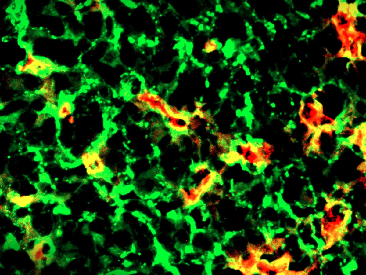 Science Translational Medicine (@sciencetm) on Twitter photo A combination therapy for #glioblastoma based on the alkylating agent CCNU and a tumor-seeking fusion protein eradicates “cold” tumors in mice and proves safe in a clinical trial involving 5 patients with this deadly brain #cancer. <a href="/UZH_en/">University of Zurich</a> scim.ag/2LC A combination therapy for #glioblastoma based on the alkylating agent CCNU and a tumor-seeking fusion protein eradicates “cold” tumors in mice and proves safe in a clinical trial involving 5 patients with this deadly brain #cancer. <a href="/UZH_en/">University of Zurich</a> scim.ag/2LC