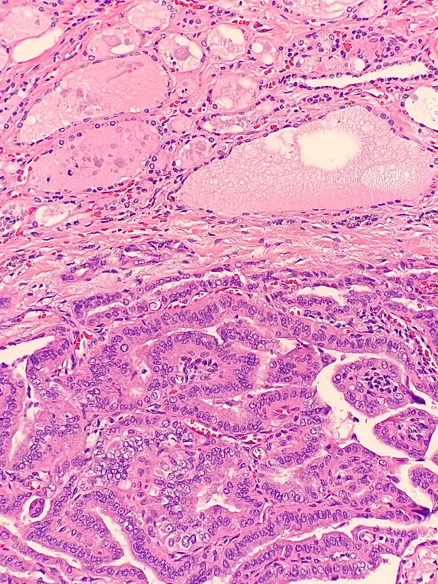 Thyroidectomy revealing eosinophilic tumor cells with tall morphology adjacent to normal thyroid tissue. What is the diagnosis? Answer: kikoxp.com/posts/12977 #PathArt #PathTwitter #MedTwitter