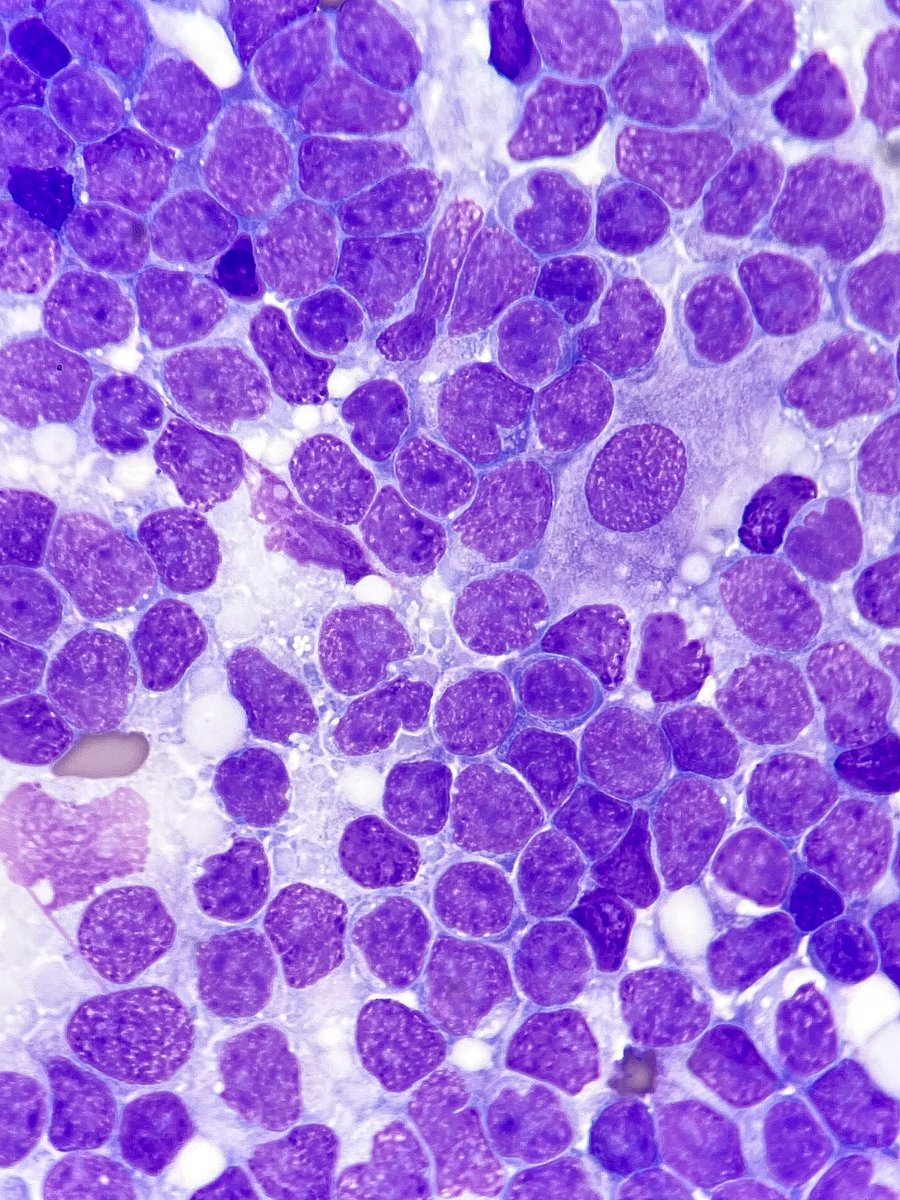 Touch preparation of mantle cell lymphoma involving lymph node. Note the angulated nuclear contours of the lymphoma cells and presence of an epithelioid histiocyte, typical features of this lymphoma.