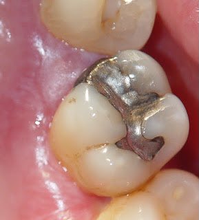 rodoepifanio's tweet photo. ¿La amalgama dental: heroina o villana? ¿Hay razones sistémicas para indicar su reemplazo? ¿Hay evidencia científica de que causa cáncer o enfermedades sistémicas? Les invito a revisar mi última entrada en mi blog  en donde revisamos estos temas.

https://t.co/oqA0Ijt1jV https://t.co/dPENzB1qyk