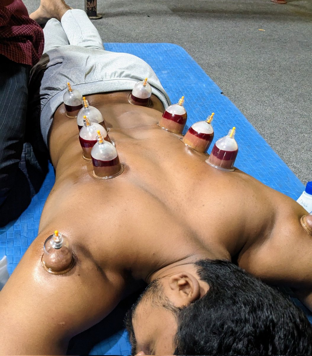 ikramkhansm's tweet photo. Hijama Therapy 🥹🩸💉
(Cupping therapy)

#hijama #cuppin #hijamatherapy #hijamacuppingtherapy #hijama https://t.co/gxcpNKLGPr