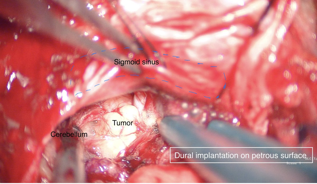 LauraB_Lopez's tweet photo. Meningioma! 1. Small durotomy to release CSF and allow cerebellum relaxation as @Ksao_ taught us 2. Desvascularize, debulk and dissect
@JesusEsteban90 #HUMS https://t.co/KsbPQuVYmx