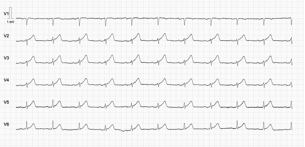 Männlich, 35 Jahre, intermittierend Brustschmerzen seit 4 h, 12-Kanal siehe unten. Prähospital ASS und Heparin? STEMI-Anmeldung ja der nein?