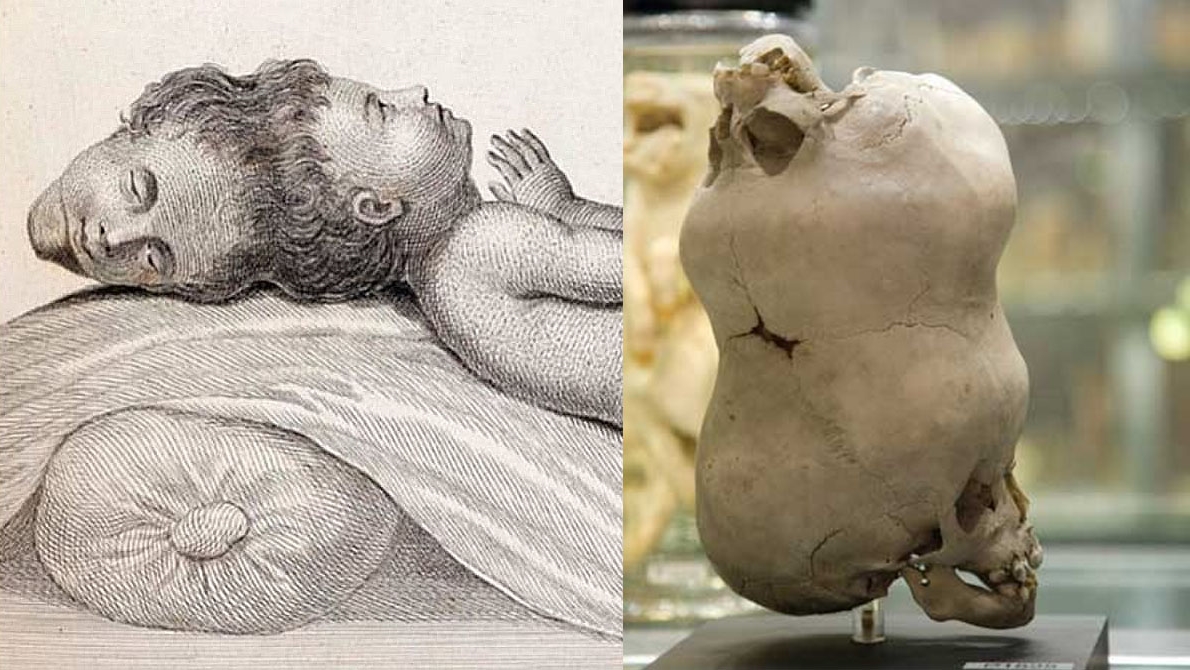 The case of the “Two-Headed Boy of Bengal". In 1783, a boy was born with two heads. The second head was upside down, with the neck pointed straight up. Shockingly, the second head was fully functional. The boy claimed he could hear the other brain telling him things. Today, his