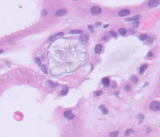 ssfarouk's tweet image. Calcium oxalate crystals in a #kidneytransplant

#KidneyPath