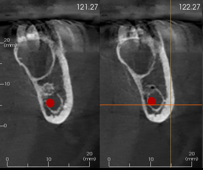 RayXDiagnostics's tweet photo. Multiple Odontogenic Keratocysts occupying the right and left mandible in a case of Basal Cell Nevus Syndrome(Gorlin-Goltz syndrome) #dentistry #radiology  @Dentistry @DentistryToday https://t.co/86B39cb7QJ