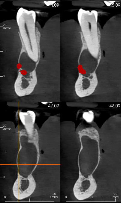 RayXDiagnostics's tweet photo. Multiple Odontogenic Keratocysts occupying the right and left mandible in a case of Basal Cell Nevus Syndrome(Gorlin-Goltz syndrome) #dentistry #radiology  @Dentistry @DentistryToday https://t.co/86B39cb7QJ