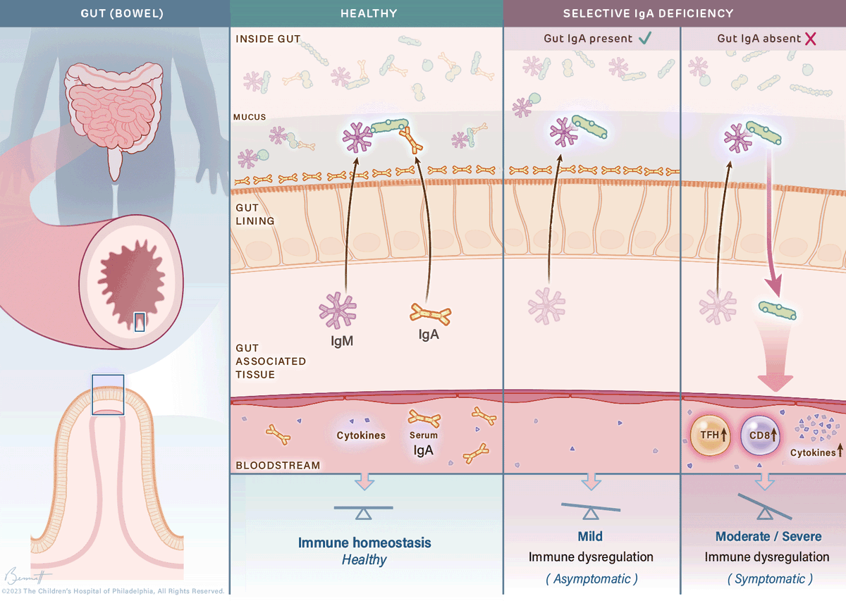 In <a href="/SciImmunology/">Science Immunology</a>, <a href="/ChildrensPhila/">Children's Hospital</a> researchers provide new model for understanding the most common primary #immunedeficiency in children, Selective IgA deficiency. ms.spr.ly/6013gjhZ1
Image: ©2023 Children's Hospital of Philadelphia. All rights reserved. Illustr.  B. Bennett.
