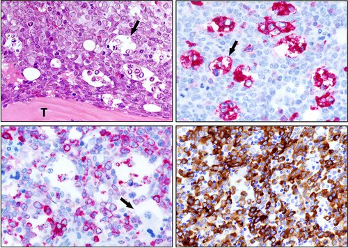 NPM1-mutated AML with starry sky pattern: images in haematology
onlinelibrary.wiley.com/doi/10.1111/bj…  
#leusm